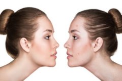 婴儿晒黄疸能不能晒脸